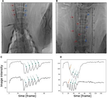 Effects of helical centerline stent vs. straight stent placement on blood flow velocity